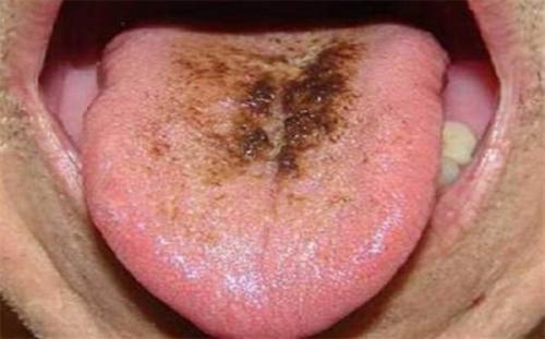 7 دلیل احتمالی ایجاد لکه های تیره بر روی زبان