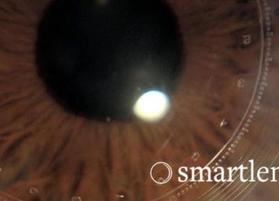 لنز تماسی miLens می تواند فشار داخل چشم بیماران مبتلا به گلوکوم را به صورت پیوسته مقدار گیری کند