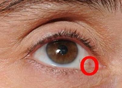 علائم سرطان چشم چیست و روش درمان آن چه می باشد؟